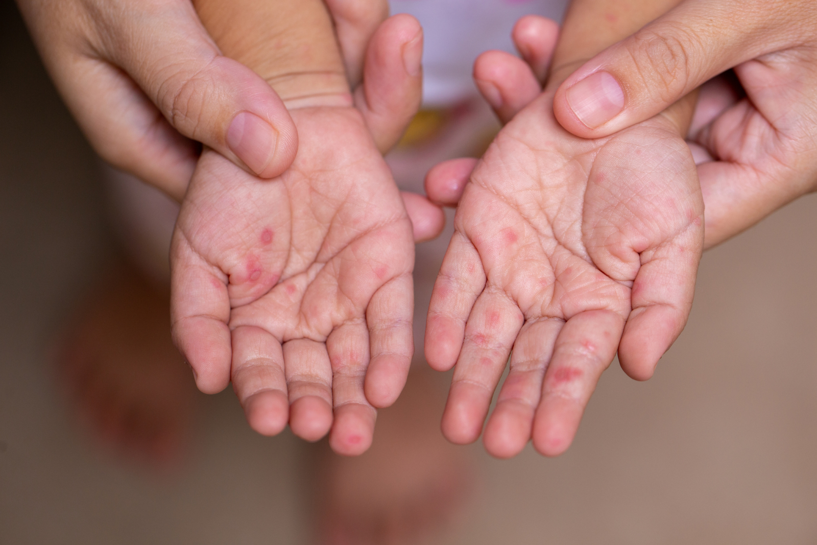 An adult holds out a child's hands, which appear to have red blisters on them, indicating possible hand, foot, and mouth disease
